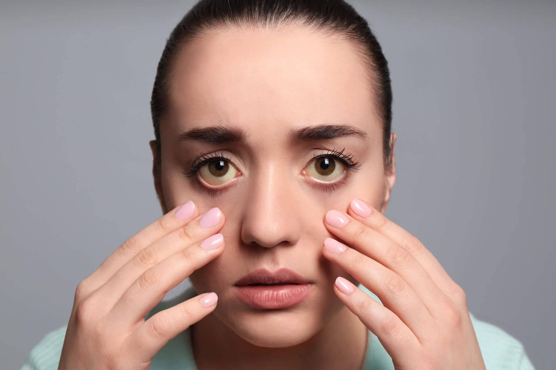 ¿Cuáles son las causas de los ojos amarillos y dónde tratarlos?, el Instituto Oftalmológico Dexeus lo explica