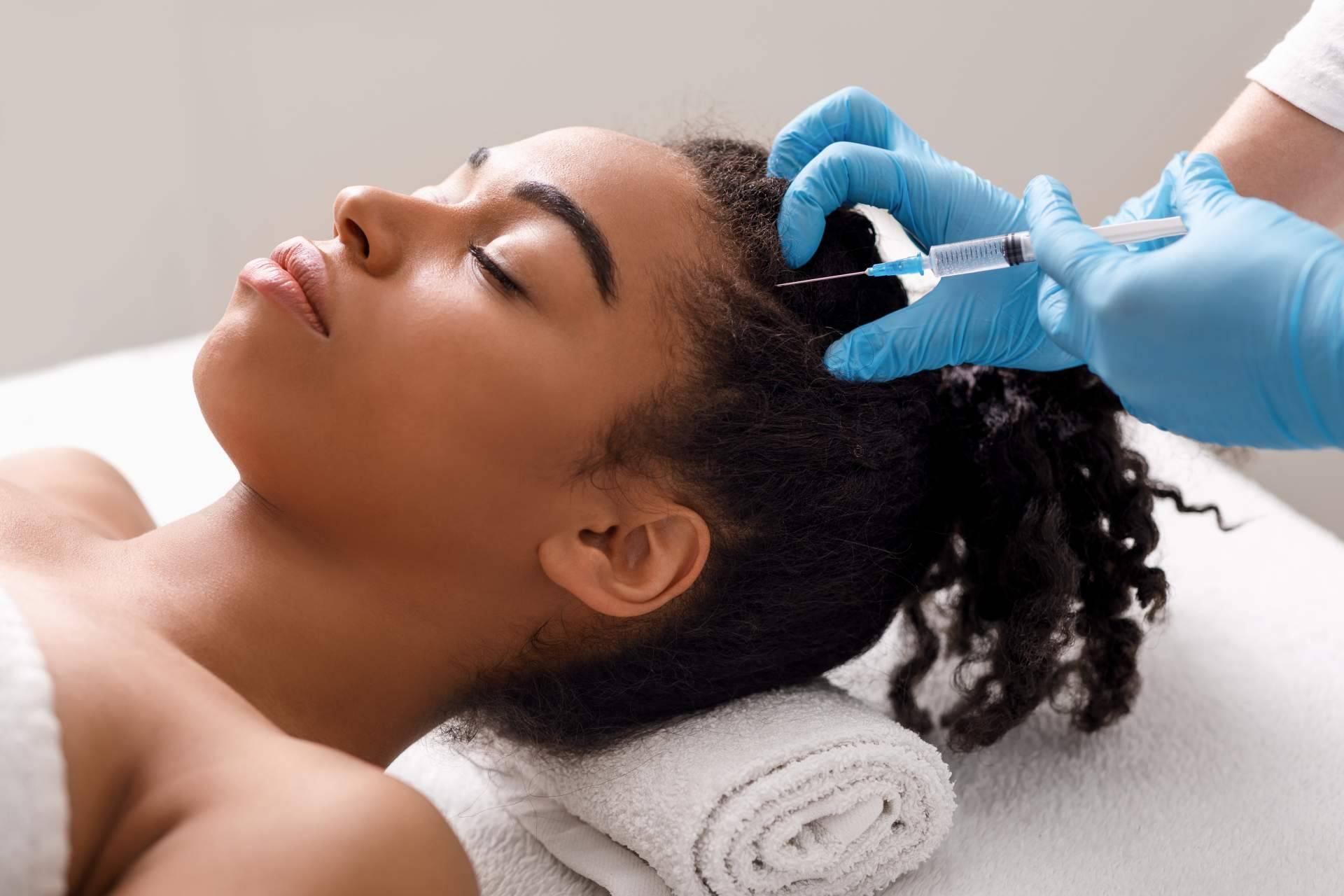 Tratamiento de la alopecia androgenética con exosomas, un método innovador que llega de la mano de Alluring Clinic