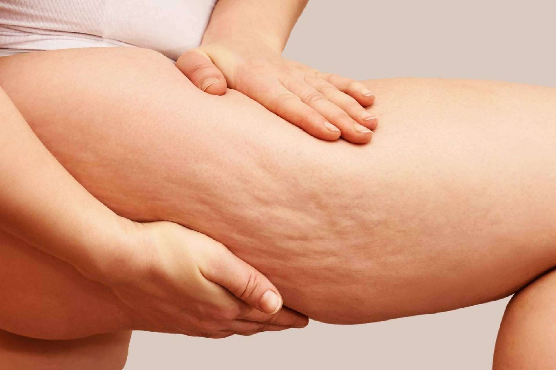 ¿Cuáles son las posibles causas y soluciones de la celulitis?