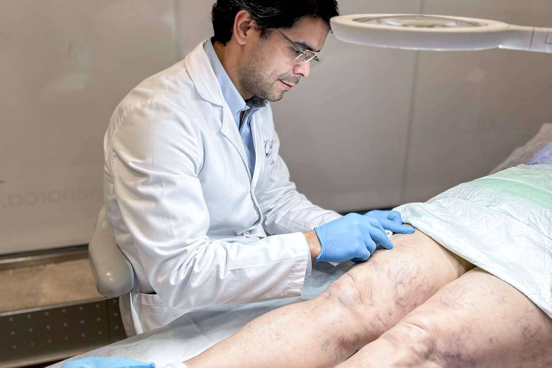 Eliminación de varices sin cirugía
