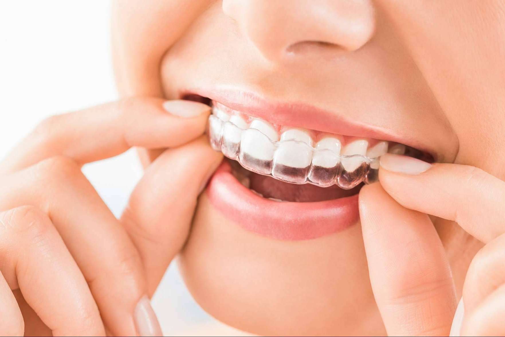 Descubrir una sonrisa con avanzada tecnología, Clínicas Nobel ofrece previsualizar tratamientos en 3D