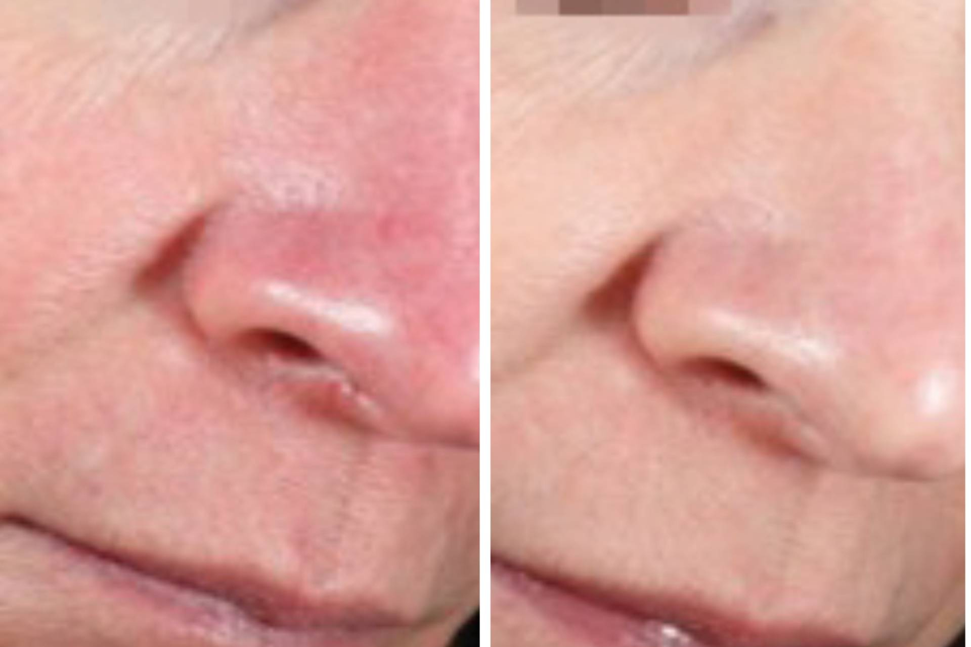 Rosácea y couperosis mejoran en pocas sesiones con el láser vascular